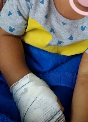 Bebê que teve dedo amputado recebe alta em São Gonçalo (RJ)