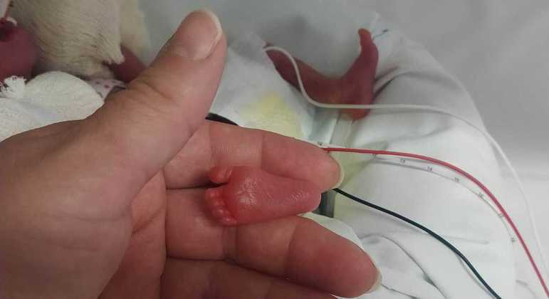 Bebê prematura extrema, que nasceu com apenas 335 g e 25 cm, recebe alta sem sequelas graves