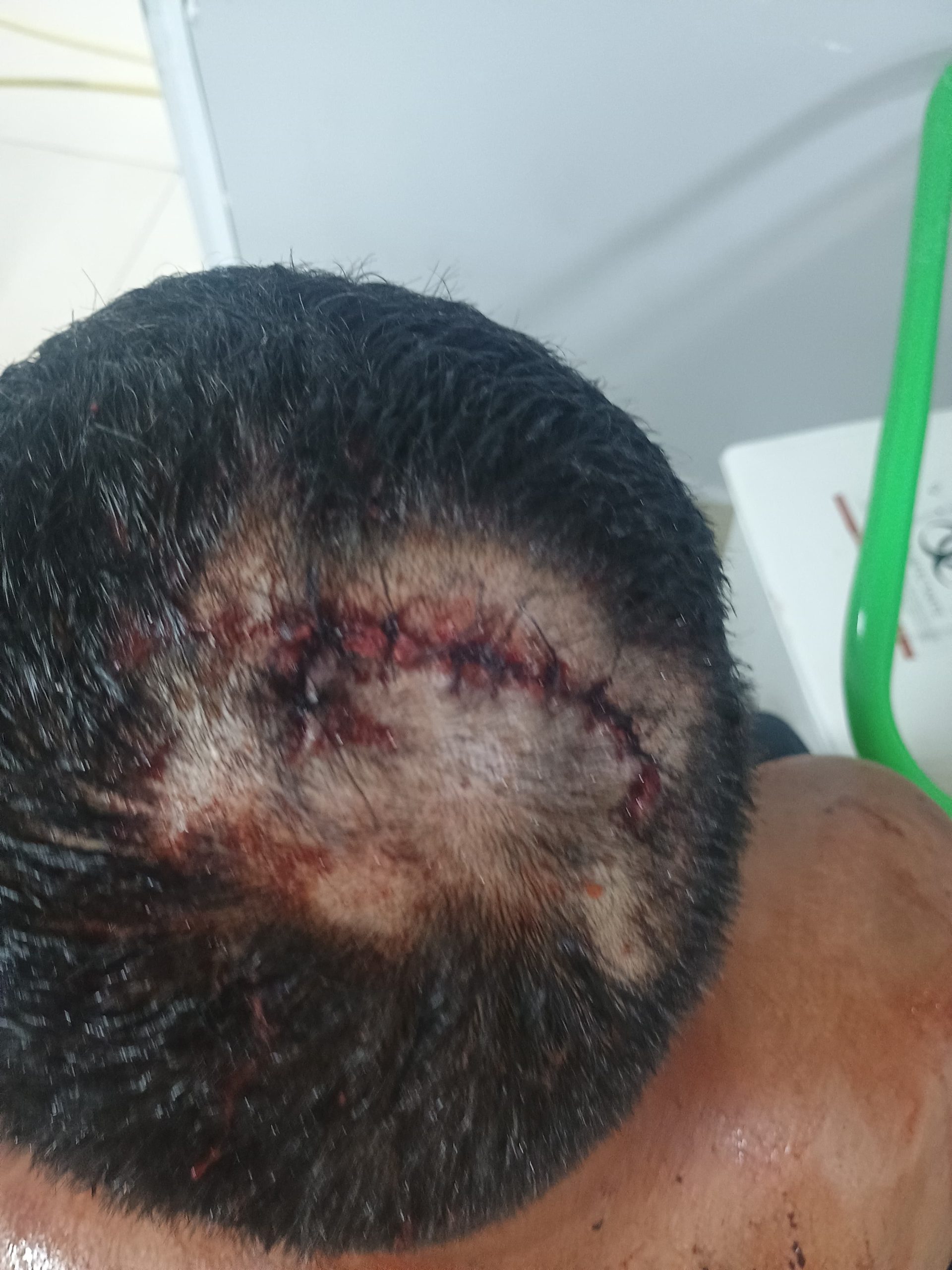 Homem é lesionado por dois menores em Crateús
