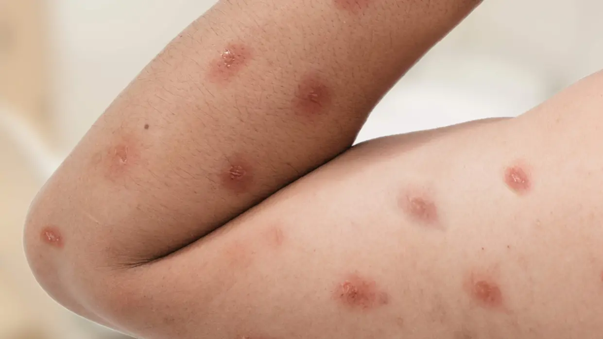 SAÚDE – Ministério da Saúde confirma 88 casos de mpox no Brasil