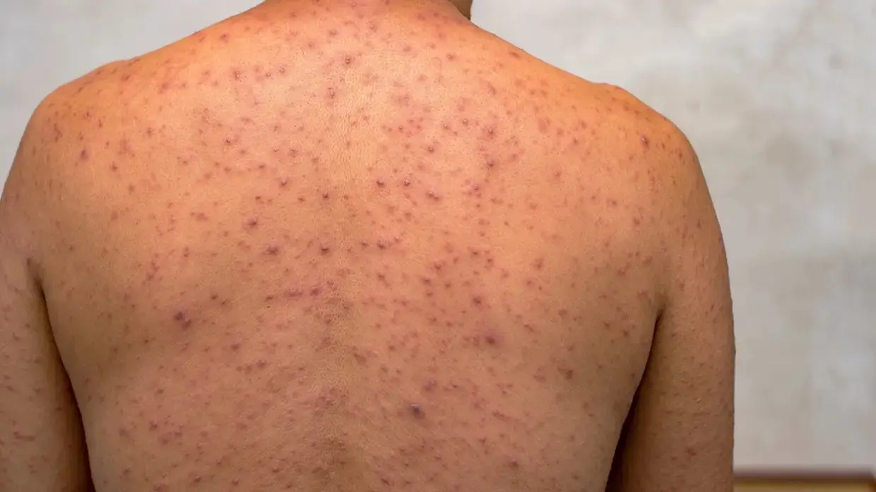 SAÚDE – Ceará confirma segundo caso de Mpox em 2026