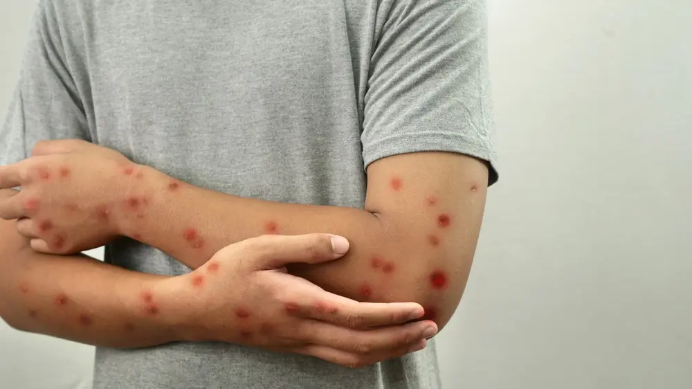 SAÚDE – Ceará confirma terceiro caso de Mpox em 2026