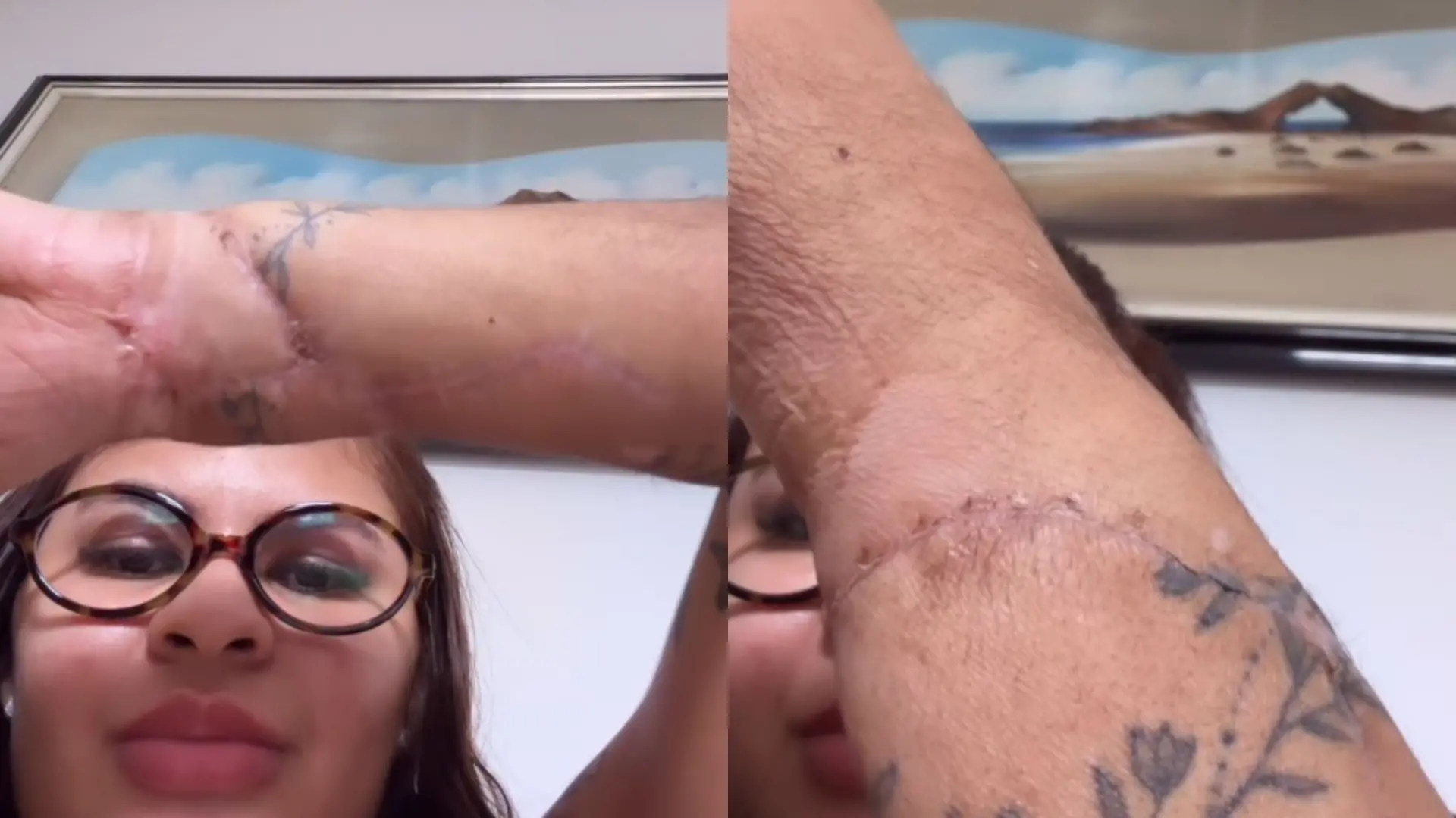 CEARÁ – ‘Marcas do meu milagre’: Ana Clara mostra cicatrizes após reimplante das mãos