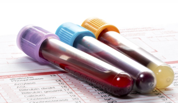 SAÚDE – Exame de sangue capaz de identificar sinais de mais de 50 tipos de câncer chega ao Brasil